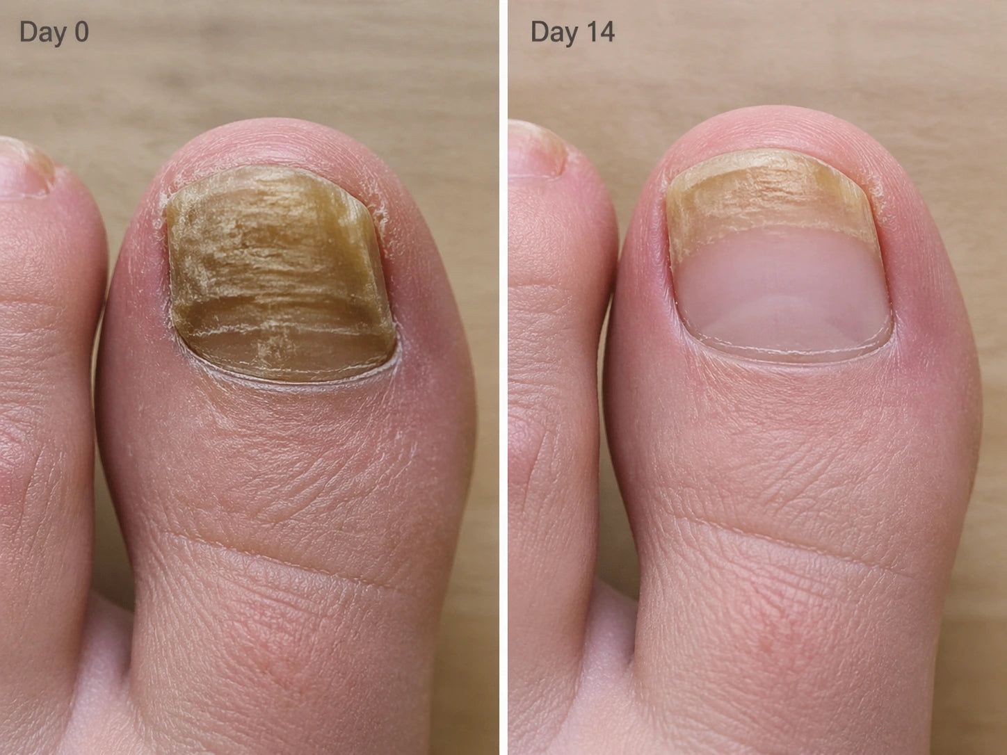 Split-screen medical case photo. Left: Margaret's big toenail at day 0, yellow and thickened from 14 years of fungus. Right: same nail at day 14, healthy pink keratin emerging at the cuticle.