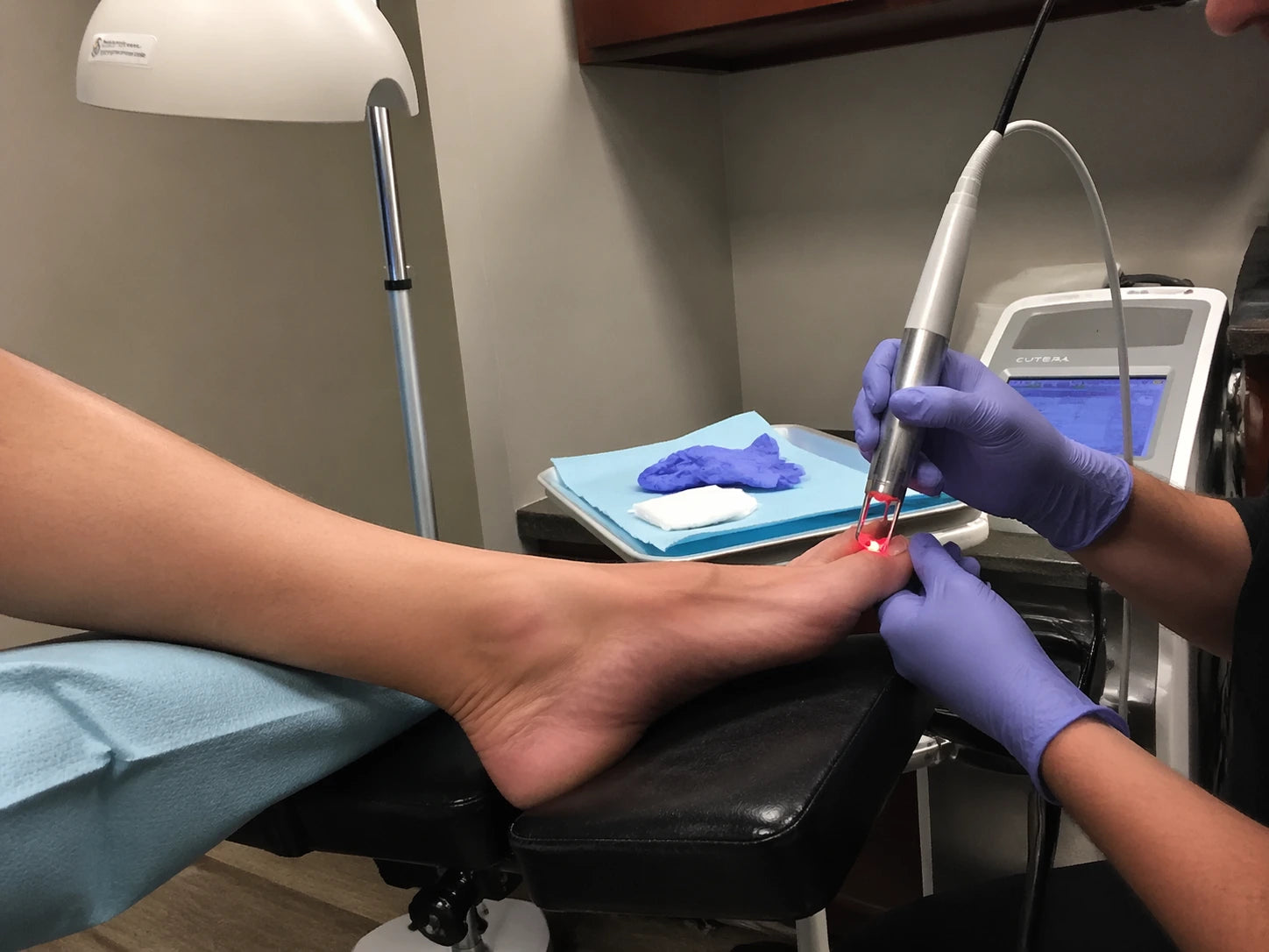 Phone snapshot of a laser nail-fungus treatment being performed in a small podiatry clinic — gloved hand pointing a handheld laser device at a patient's big toenail.