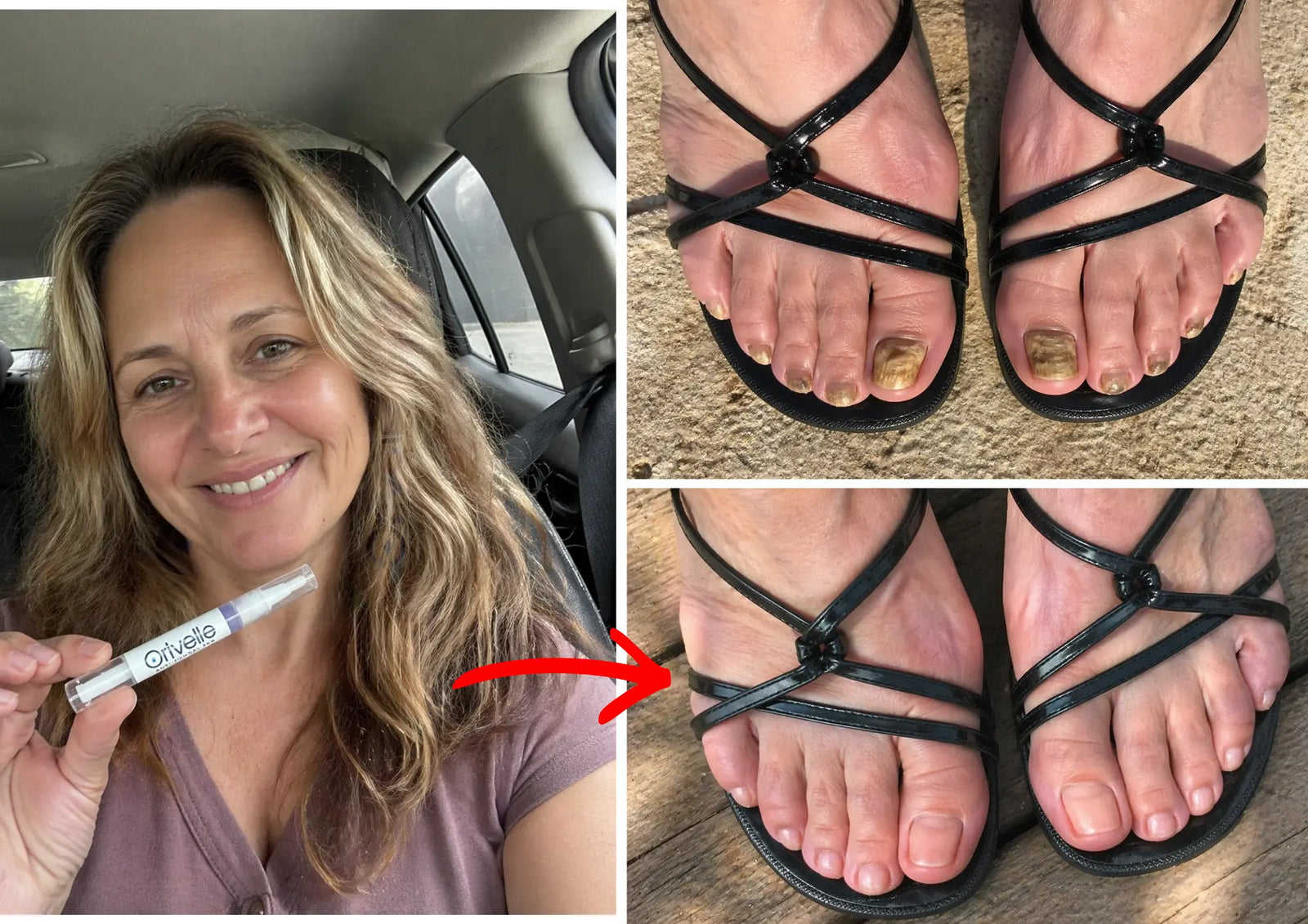 A real customer holding up the Orivelle anti-fungal pen in a candid selfie-style photo, alongside before-and-after photos of her toenails — severe fungal discoloration cleared to healthy pink-white after 14 days of nightly use. A red arrow connects the product to the clean result.