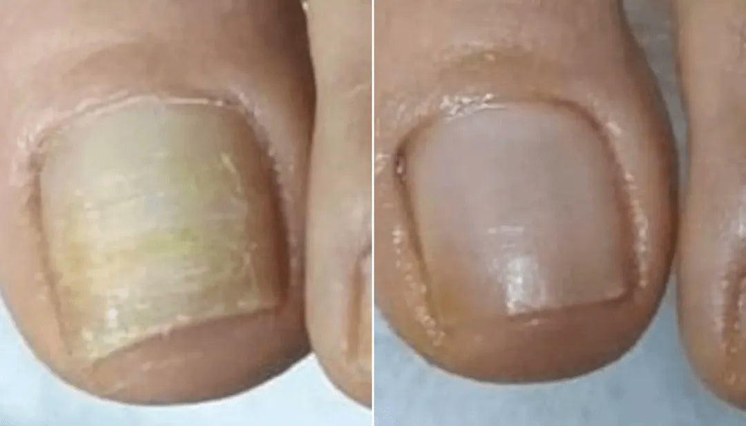 Side-by-side before/after of Margaret's big toenail — fungal damage cleared after weeks on Orivelle.