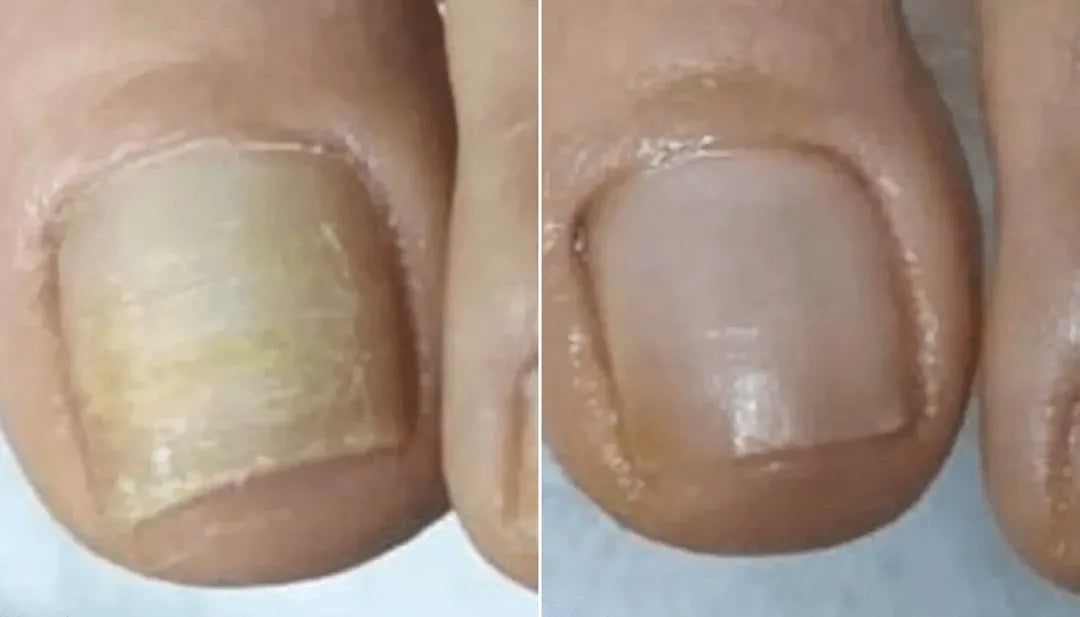 Side-by-side before/after photos of toenails – fungal damage cleared after weeks on Orivelle.